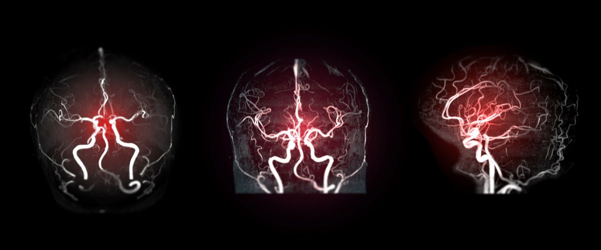 Aneurisma en Casitodoonline