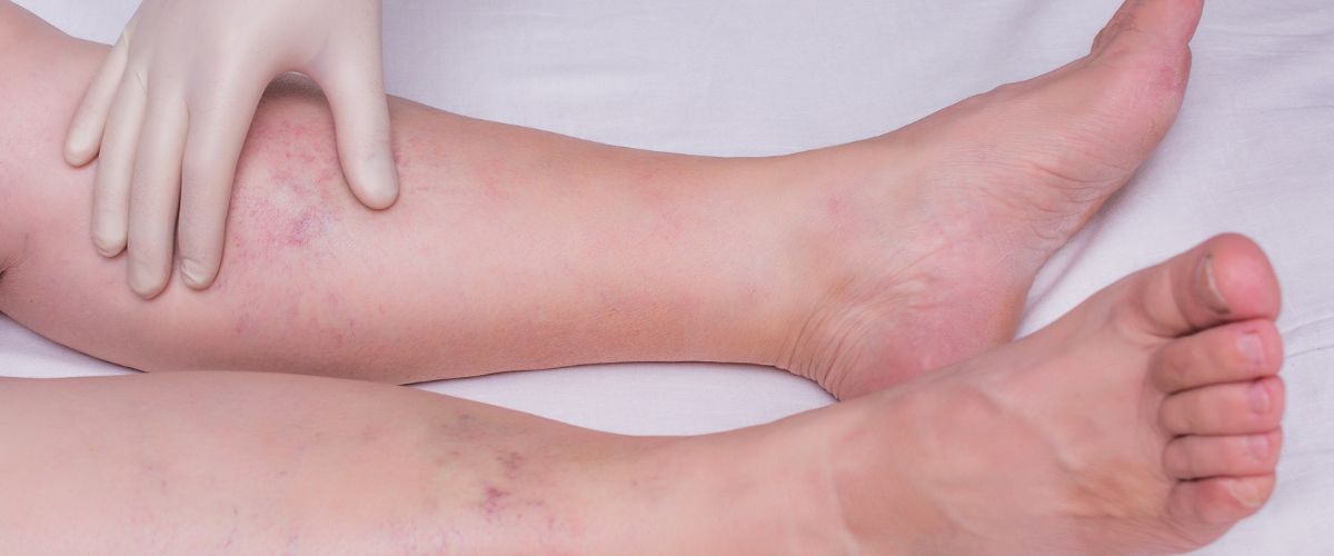 mala circulación sanguínea en Casitodoonline