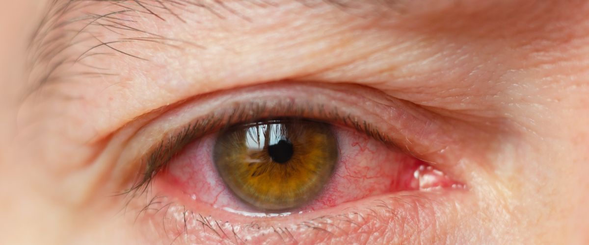 ¡Conjuntivitis y su molesta visita: descubre cómo enfrentar la conjuntivitis alérgica!