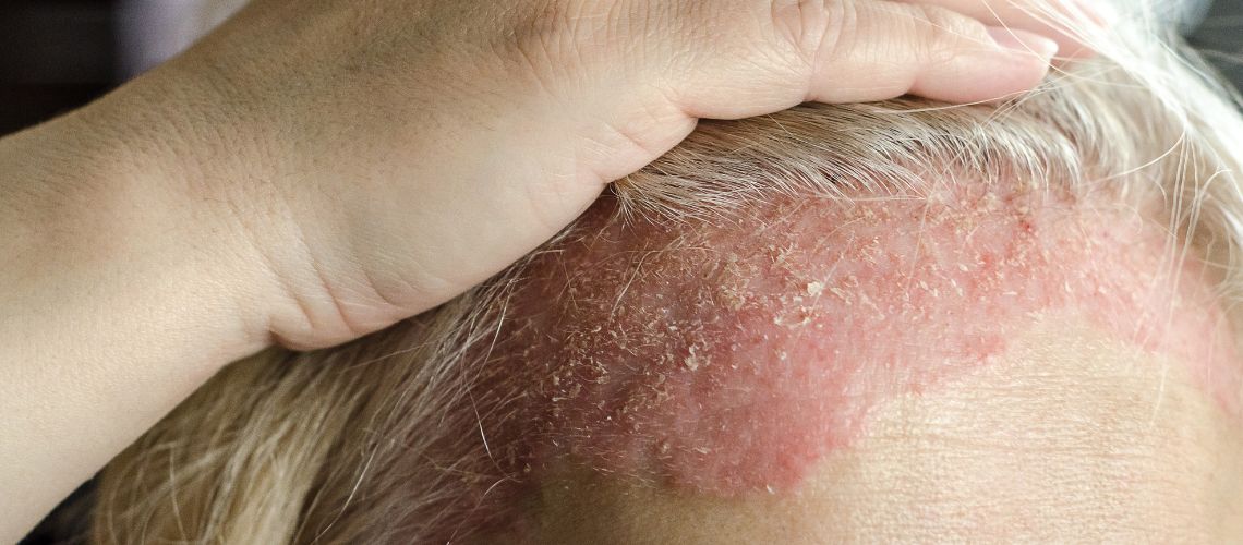 Eccema: Todo lo que Necesitas Saber y Cómo Tratarlo