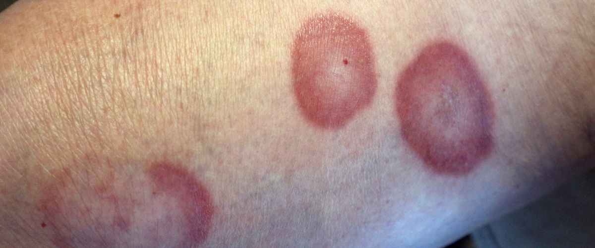 Granuloma anular en Casitodoonline