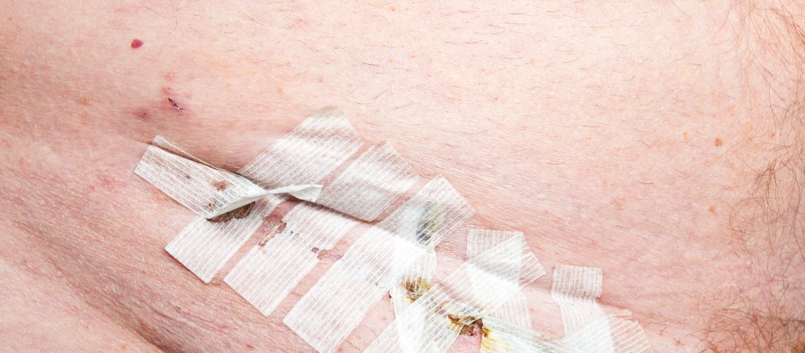 Tratamiento y prevención de la hernia inguinal