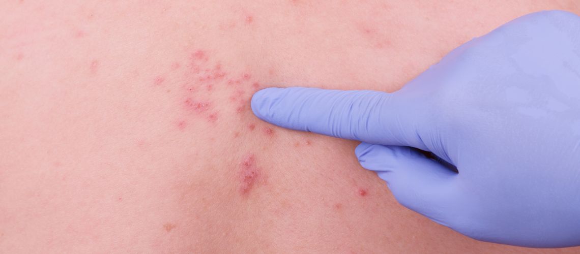 Información sobre el herpes zoster en Casitodoonline