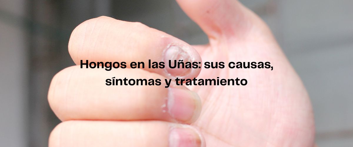 Hongos en las uñas en Casitodoonline