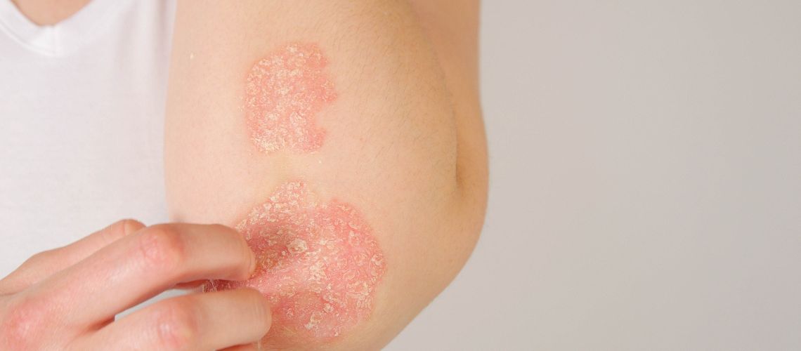 Psoriasis en Casitodoonline