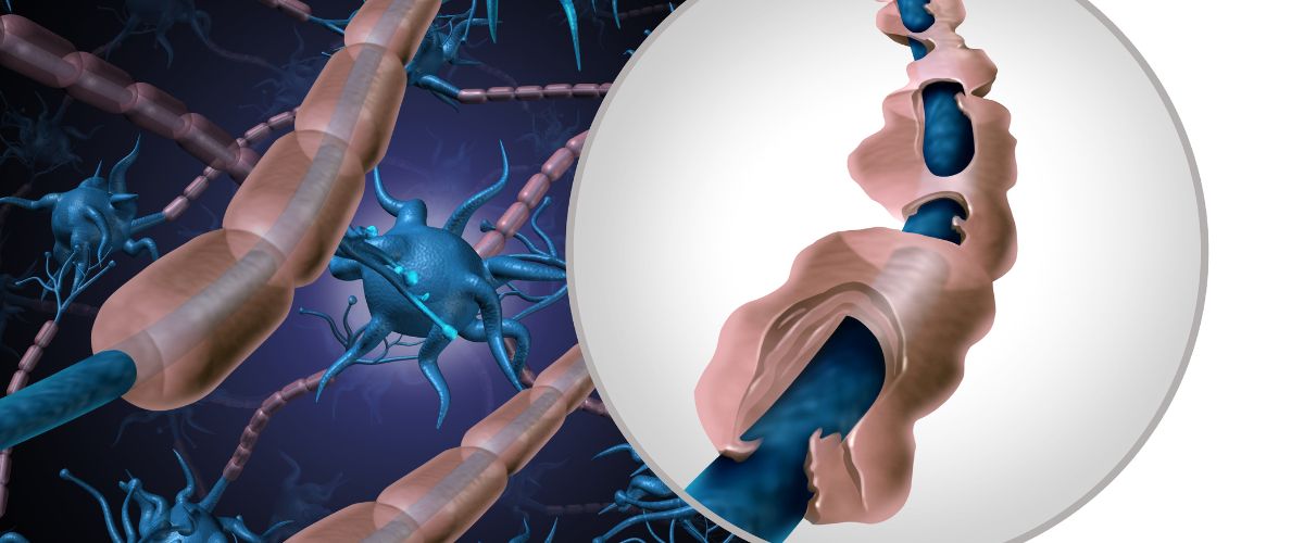 Síndrome de Guillain-Barré: Un Desafío del Sistema Nervioso