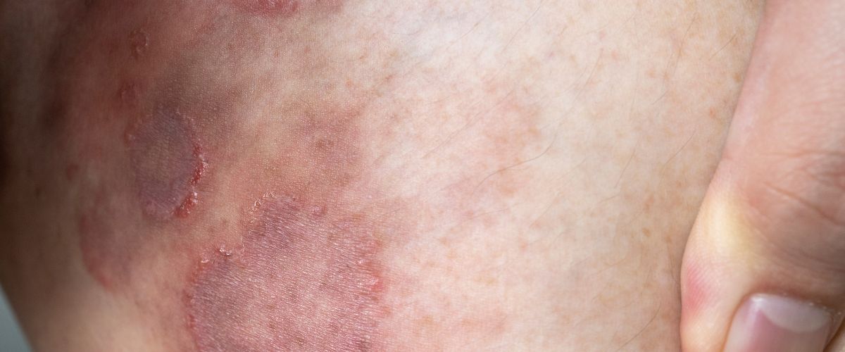 Tiña Corporal: Síntomas, Tratamiento y Prevención | Guía Completa